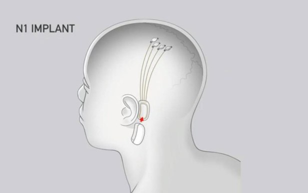 neuralink-smartphonegreece-3